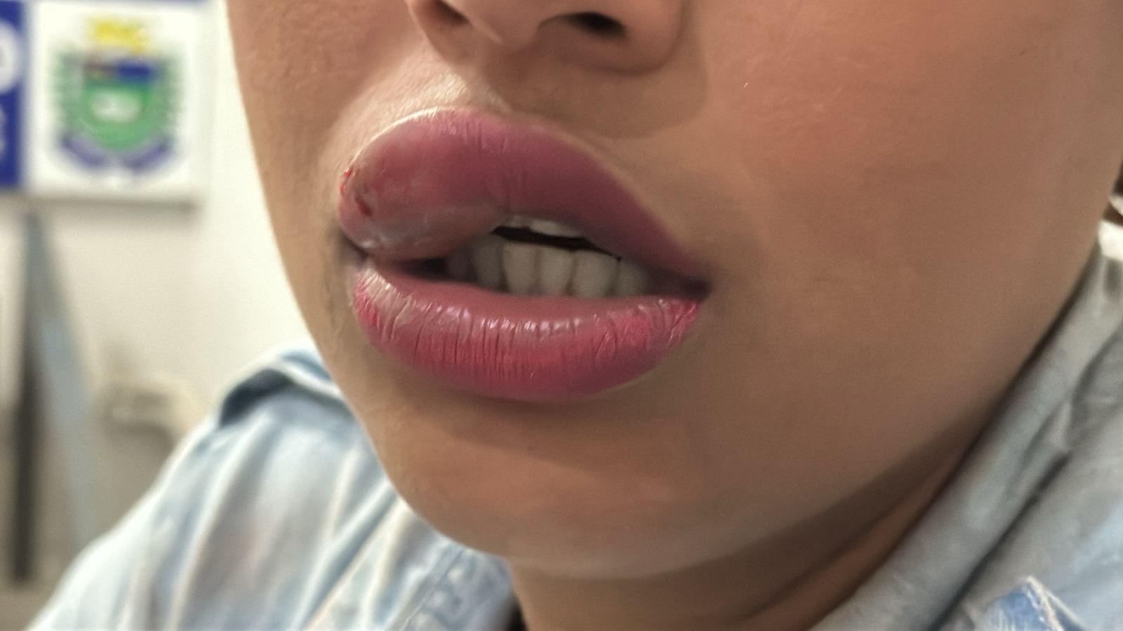 Por não aceitar que esposa usa maquiagem e roupas curtas, marido surta, agride e morde lábios da esposa na frente de crianças 