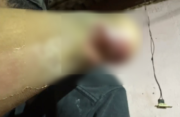 Bebê de 1 ano tem calcanhar necrosado após colocar gesso em Nova Alvorada do Sul Bebê de 1 ano tem calcanhar necrosado após colocar gesso em Nova Alvorada do Sul