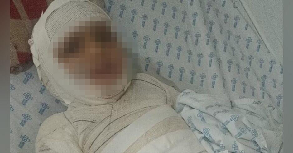 Família de criança que sofreu acidente com fogo faz vaquinha para fazer tratamento do garoto