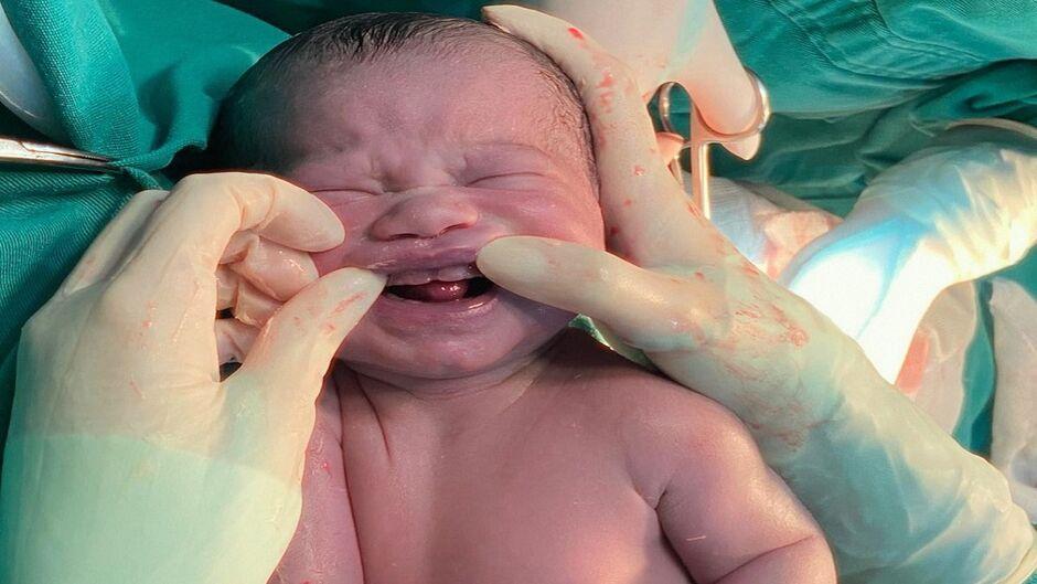 Nascimento de bebê com Nascimento de bebê com 'dentes' surpreende obstetra e mãe em Campo Grande