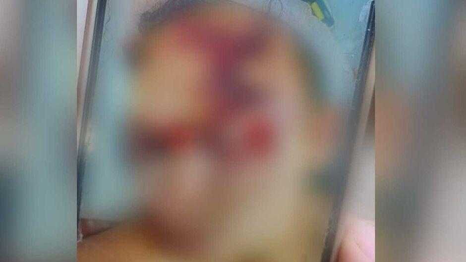 Jovem é espancado em confraternização e fica com rosto desfigurado em Sidrolândia Jovem é espancado em confraternização e fica com rosto desfigurado em Sidrolândia