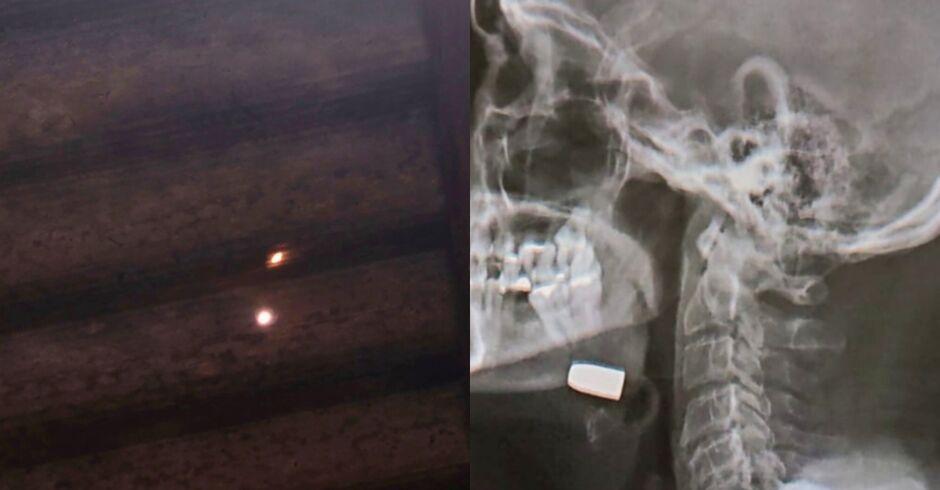 Homem é atingido por bala perdida no queixo enquanto dormia em Sidrolândia  