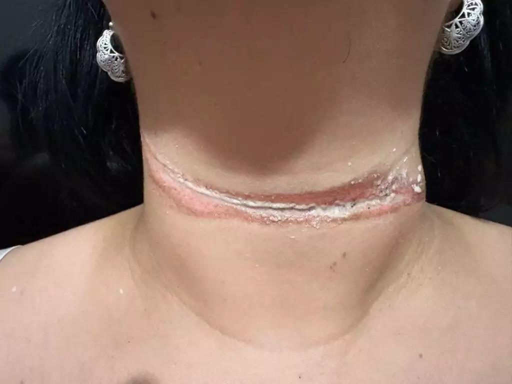 Após série de acidentes, força-tarefa intensifica retirada de fios pendurados em Três Lagoas Após série de acidentes, força-tarefa intensifica retirada de fios pendurados em Três Lagoas