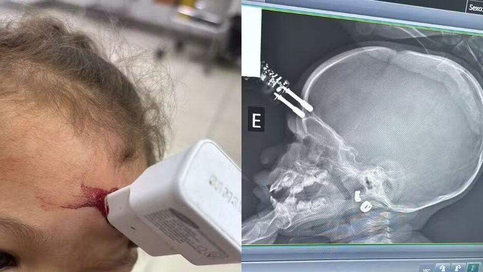 Bebê fica com carregador cravado na testa ao cair da cama em Divinópolis  