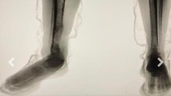 “Body Scan” entrega plano de interno: raio-X flagra cocaína escondida em tênis