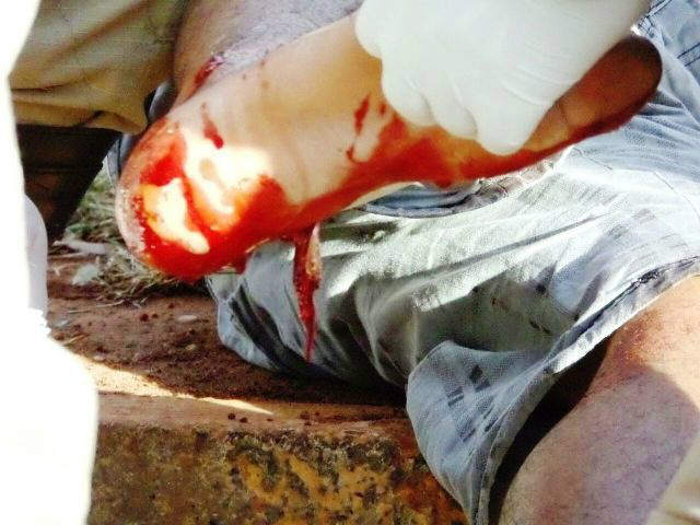 Homem sofre fratura exposta grave ao cair com motocicleta