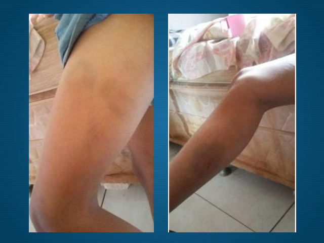 Criança de 9 anos é espancada com corrente de bicicleta depois de brigar com irmã