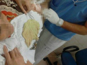 Meses depois de cirurgia, filha descobre pano esquecido em barriga de mãe Meses depois de cirurgia, filha descobre pano esquecido em barriga de mãe