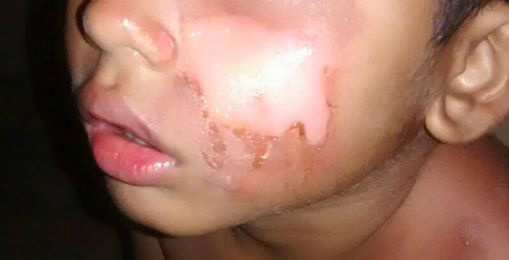 Criança de 05 anos pede comida à mãe que joga feijão quente no rosto do filho 