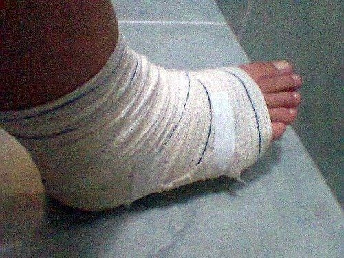 Jovem pisa em “bombinha” em parque de exposições e sofre corte profundo no pé