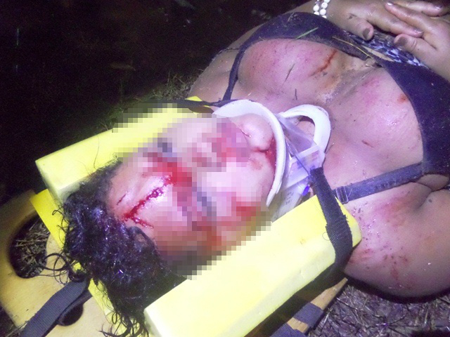  Jovem desequilibra moto em poça d’água e ao cair, sofre ferimentos na face 