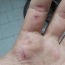 Após pular o portão de residência, cachorro ataca e morde moradora do bairro Santa Rita 