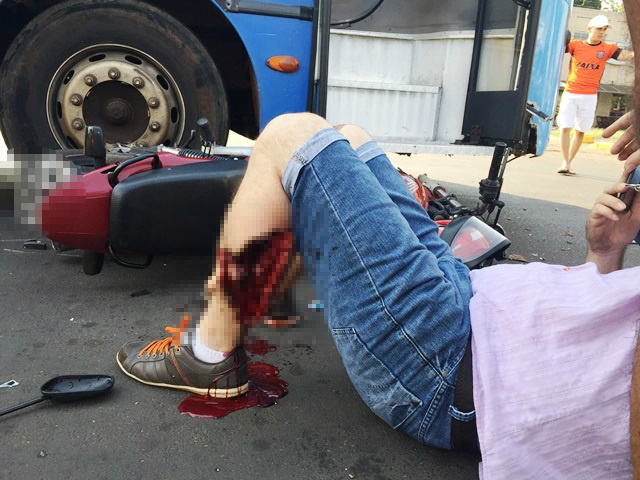 Acidente grave deixa motociclista de 31 anos com fratura exposta 