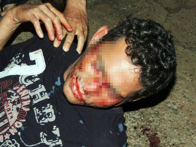 Briga em bar deixa cliente com suposta fratura no nariz 