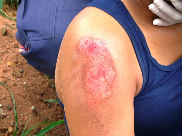 Mulher fica ferida em acidente entre motos no São João
