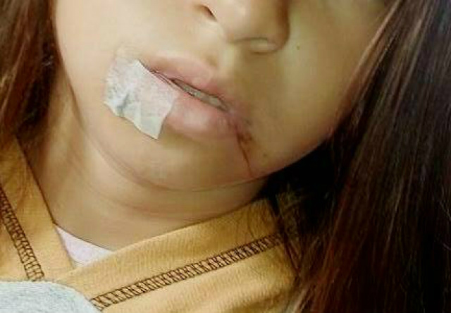 Menina de 10 anos fica ferida por linha de pipa em Três Lagoas Menina de 10 anos fica ferida por linha de pipa em Três Lagoas